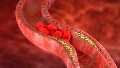 Study Finds Better Way To Predict Heart Disease And Who Needs Statins