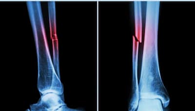 New AI Tool Detects Hidden Heart And Fracture Risks In Bone Scans Within Seconds, Say Scientists